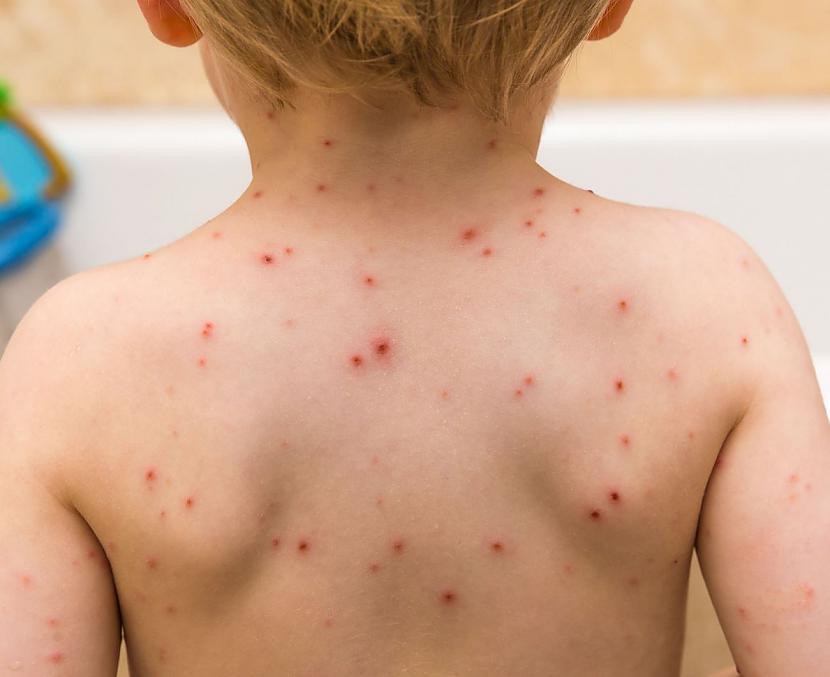 MasalasCilvēki no attīstītās... Autors: Lestets Nāvējošākie vīrusi vēsturē