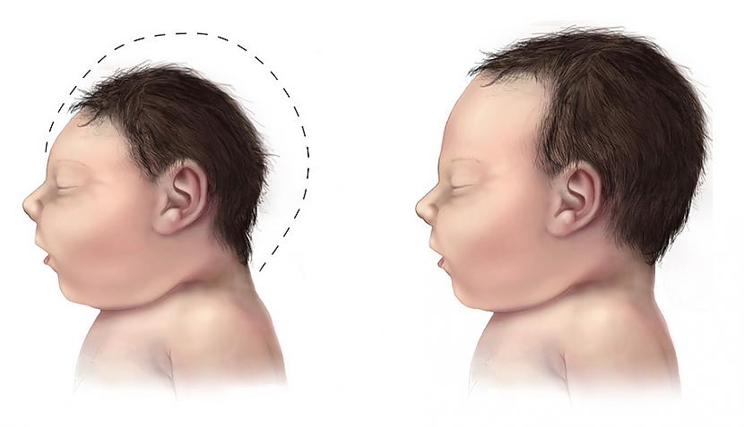 MikrocefālijaStarp... Autors: Lestets 13 ģenētiskās mutācijas, kas var rasties incesta rezultātā