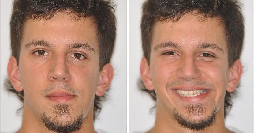 Izteikta asimetrijaIncests... Autors: Lestets 13 ģenētiskās mutācijas, kas var rasties incesta rezultātā